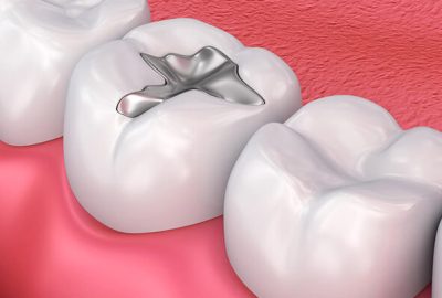 KFEGGM Metall dental fillings, Medically accurate 3D illustration